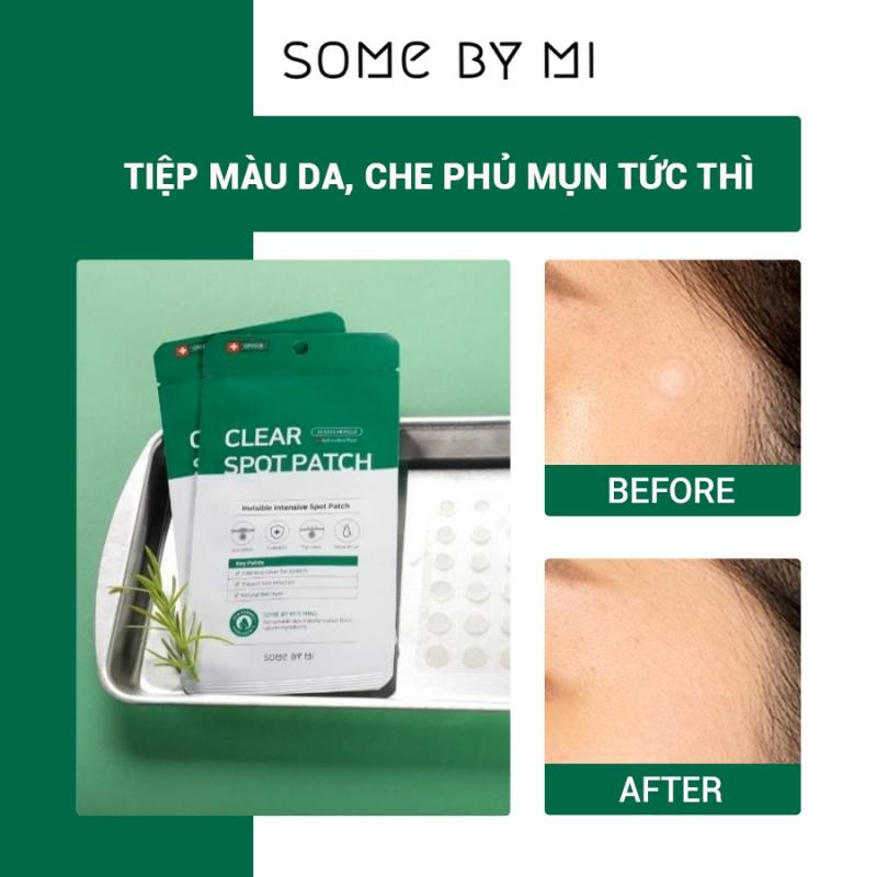 Miếng dán mụn Some By Mi Don't Pop It. Just Leave It 18Pcs