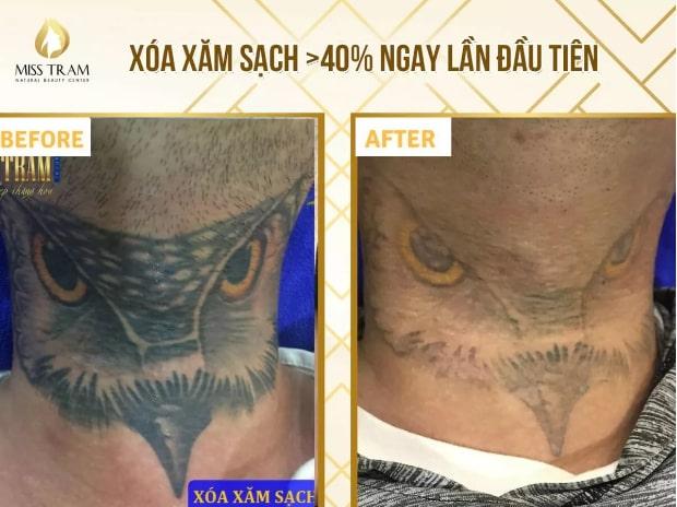 Miss Tram Spa – Chuyên xóa xăm tận gốc không sẹo hơn 15 năm kinh nghiệm