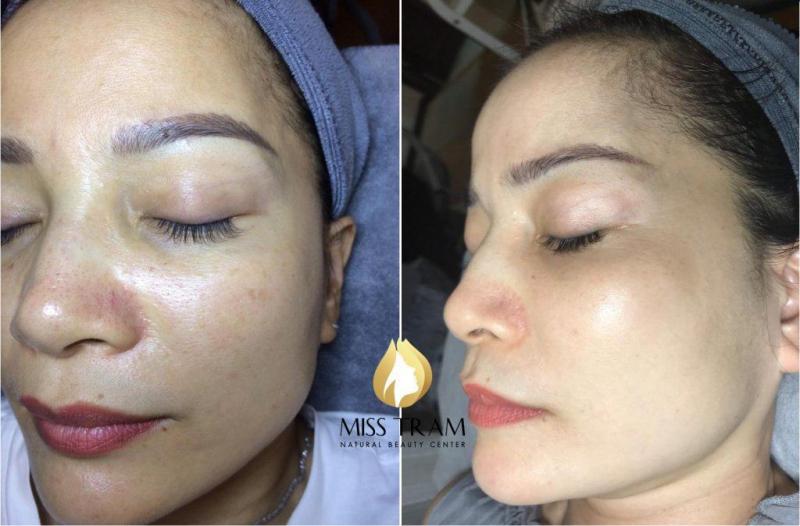 Miss Trâm Spa: Nơi chuyên điều trị nám, tàn nhang uy tín hơn 15 năm ở HCM