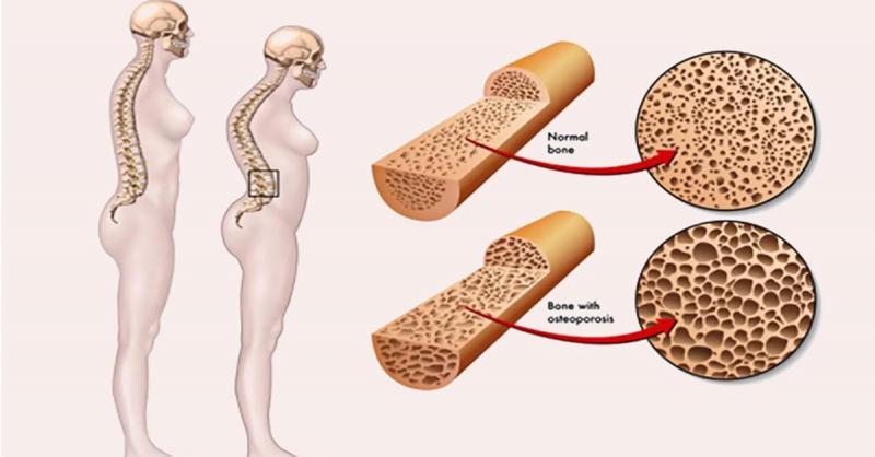 Một trong những bệnh ý về xương