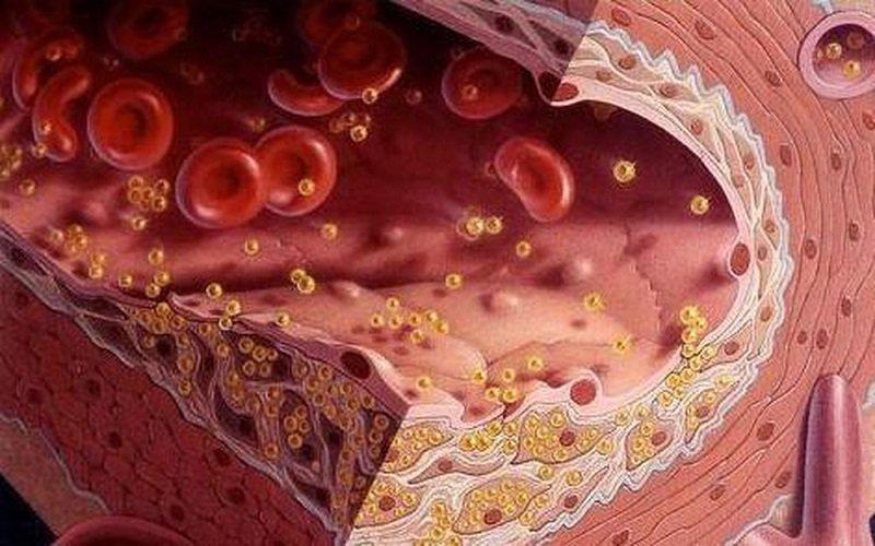 Mỡ máu hay còn gọi là cholesterol