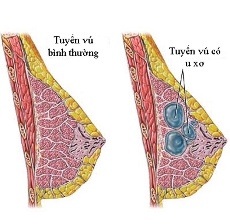 Nuôi con bằng sữa mẹ giúp ngăn ngừa ung thư vú.