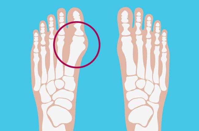 Ngón chân bị biến dạng