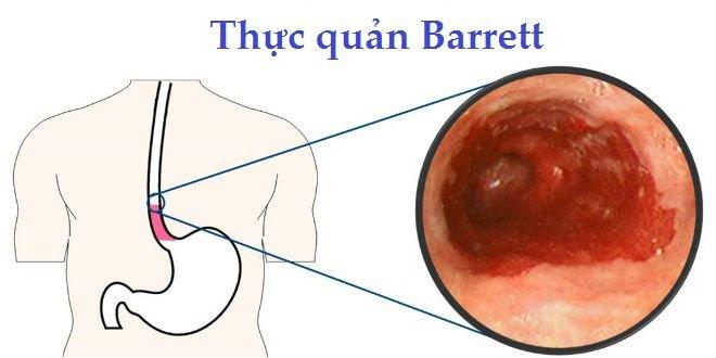 Bệnh viêm thực quản Barrett