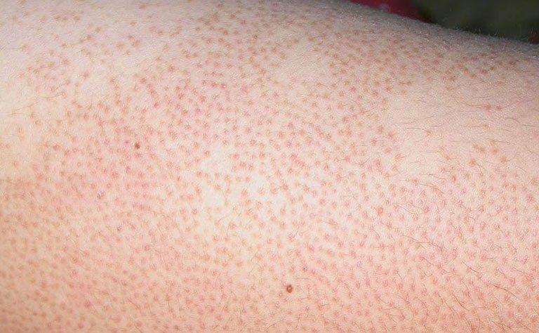 Nguyên nhân dẫn tới viêm nang lông