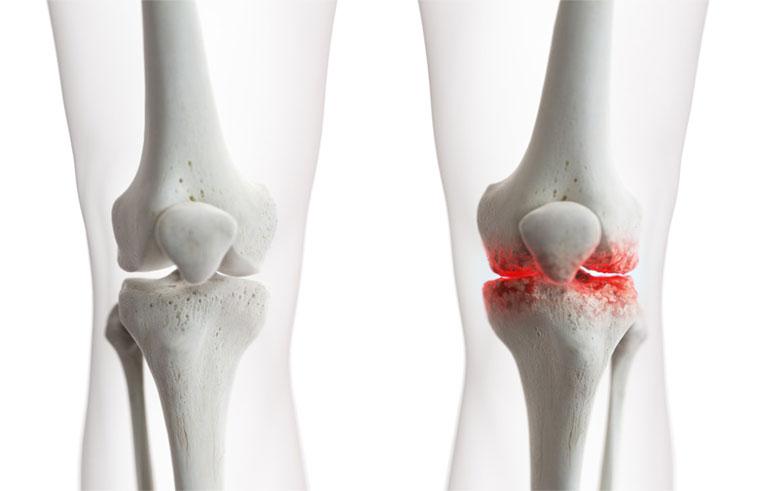 Thoái hóa khớp - Một trong những nguyên nhân gây bệnh viêm khớp