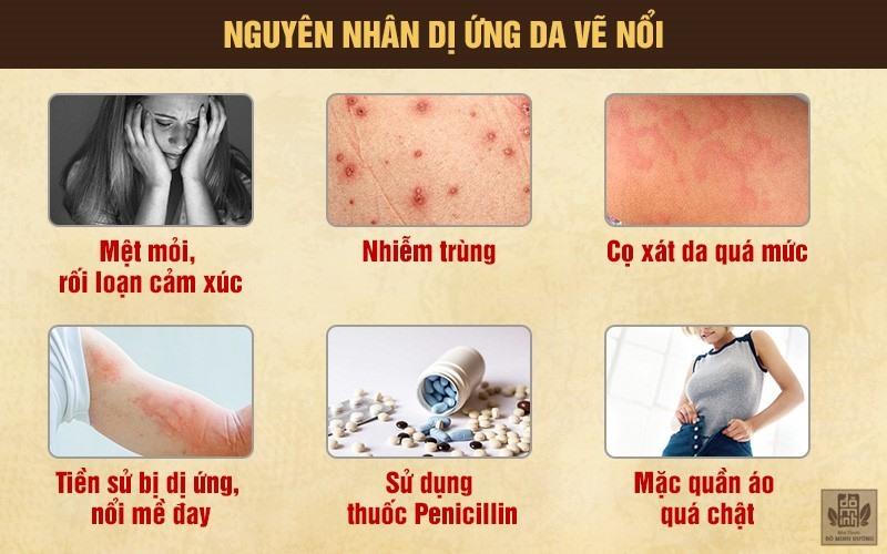 Nguyên nhân gây dị ứng da vẽ nổi
