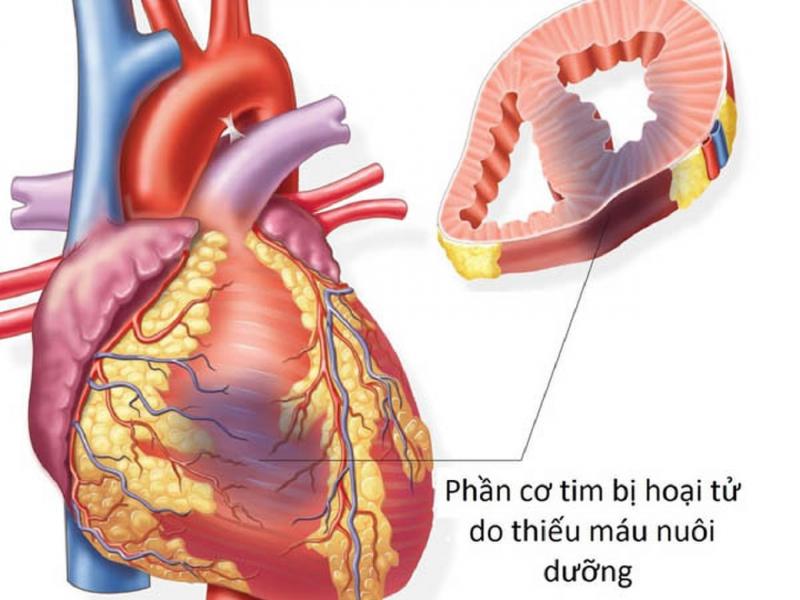 Nguyên nhân gây nhồi máu cơ tim cấp?