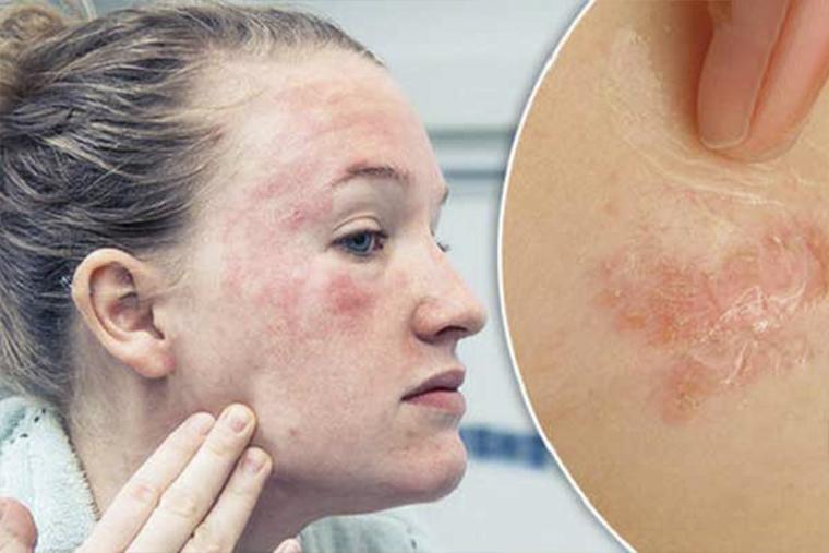 Viêm da cơ địa do sử dụng nhiều hóa mỹ phẩm