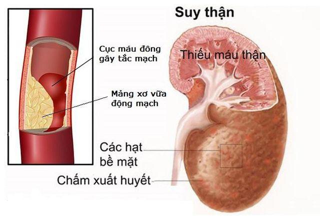 Xơ vữa động mạch gây nên tình trạng suy thận