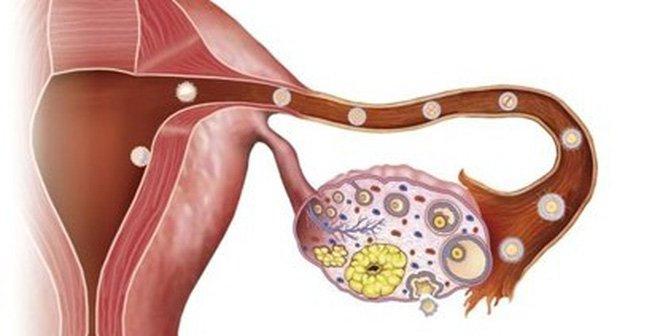 Tiền sử gia đình bị ung thư buồng trứng