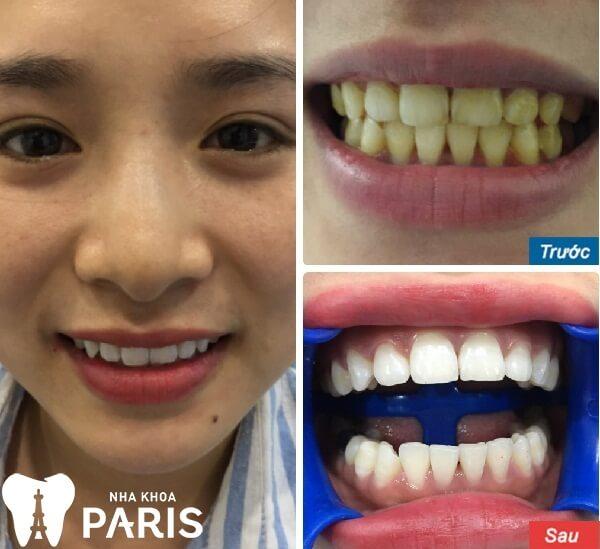 Khách hàng tẩy trắng răng tại nha khoa Paris Hải Phòng