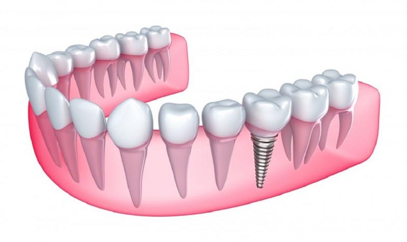 Cấy ghép Implant