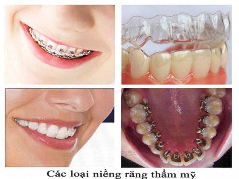 Các loại niềng răng thẩm mỹ tại Nha khoa Đức Hậu