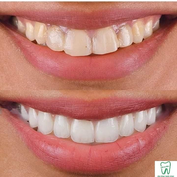 Nha Khoa Mạnh Chiến Lạng Sơn