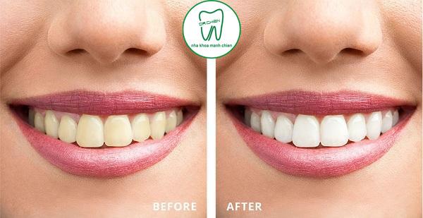 Nha Khoa Mạnh Chiến Lạng Sơn