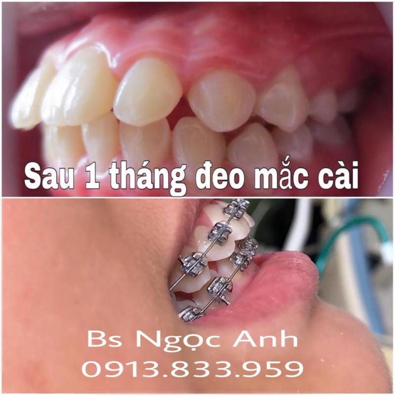 Khách hàng sau 1 tháng sử dụng chỉnh nha tại Nha khoa Ngọc