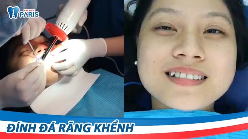 Khách hàng đính đá lên răng tại Paris