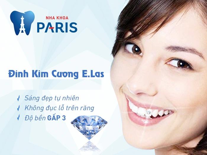 Đính đá lên răng tại nha khoa Paris
