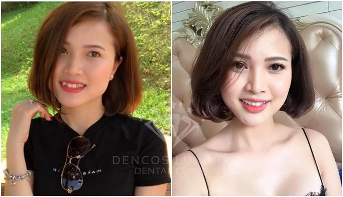Khách hàng bọc răng sứ tại Dencos Luxury