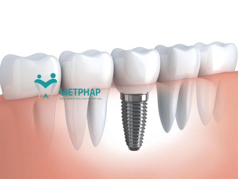 Kỹ thuật trồng răng implant