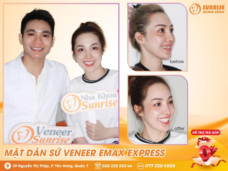Mặt Dán sứ  Veneer Emax Express tại Nha Khoa Sunrise