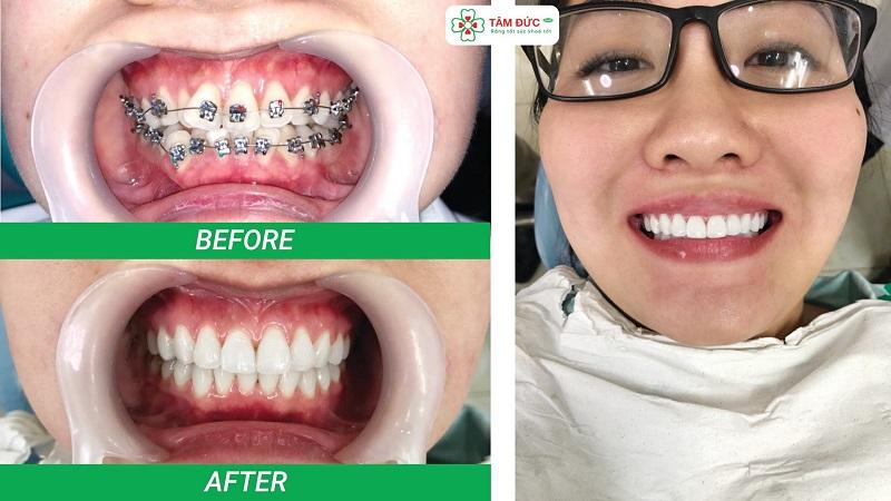 Khách hàng niềng răng tại Nha khoa Tâm Đức Smile Vũng Tàu