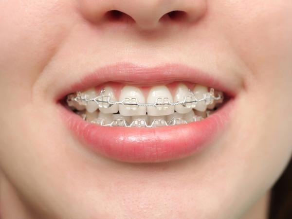 Niềng răng mắc cài tự buộc