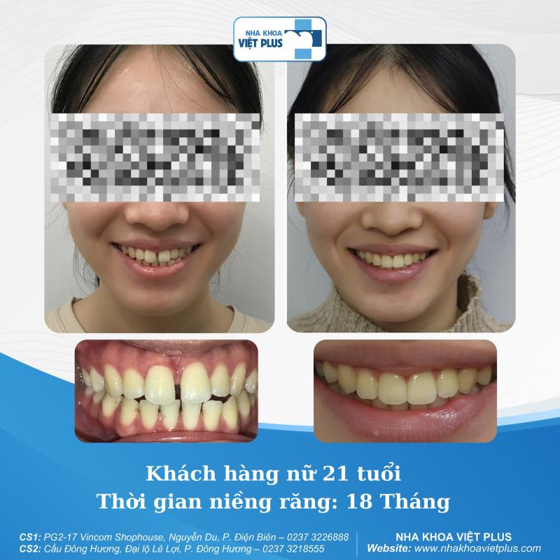 Nha Khoa Việt Plus