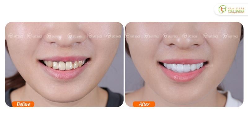 Tháo sứ cũ, điều trị viêm - Bọc răng sứ mới