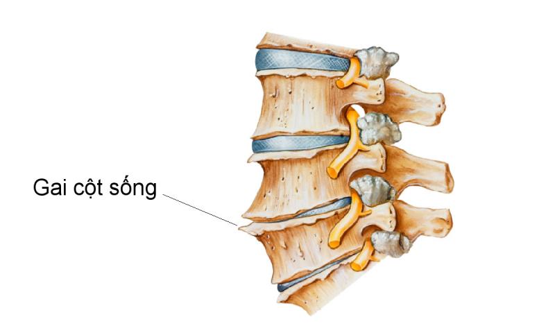 Hình ảnh minh họa bệnh gai cột sống