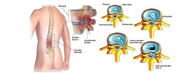 Mô phỏng các bệnh về xương