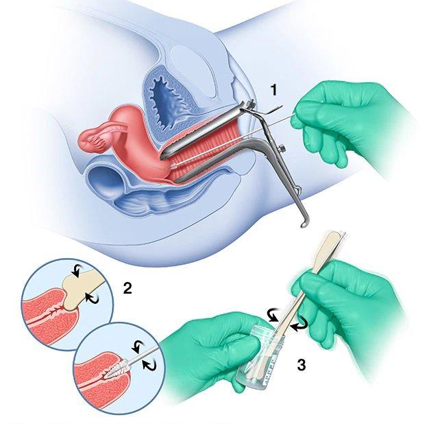 Quy trình thực hiện xét nghiệm PAP