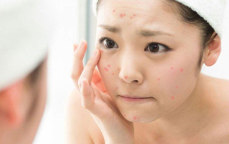 Nổi mụn trên mặt