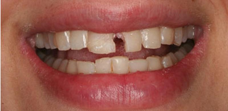 Nước đá gây sâu răng, hỏng răng