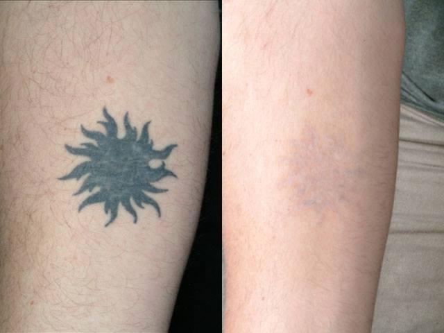 Orion tatoo xóa hình xăm an toàn không để lại sẹo