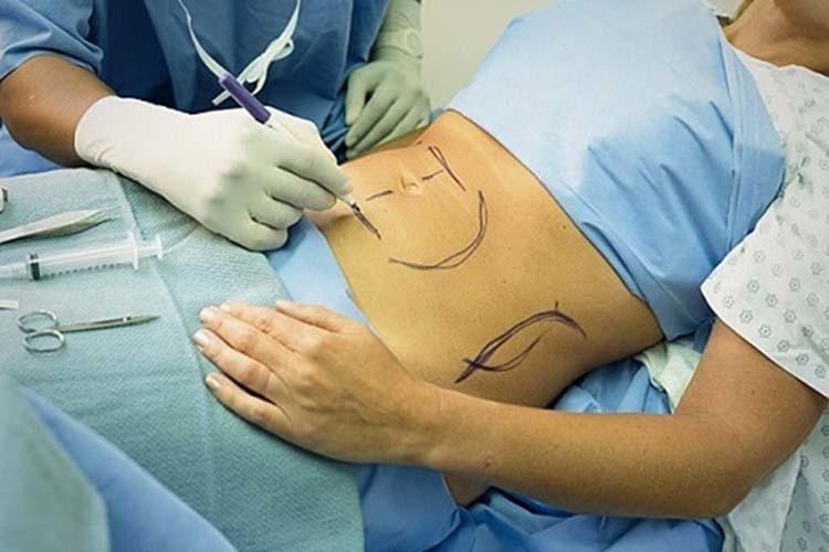 Phẫu thuật thu nhỏ dạ dày để giảm béo
