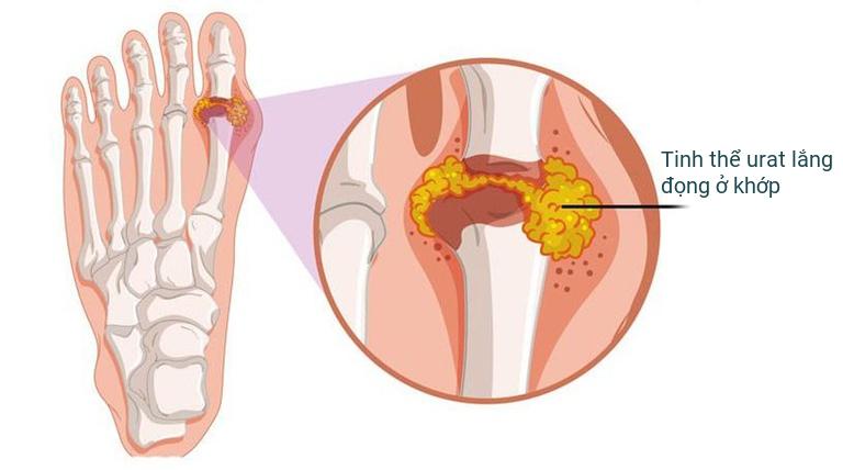 Phó Giáo sư, Tiến sĩ Nguyễn Đình Khoa chuyên chữa Gout