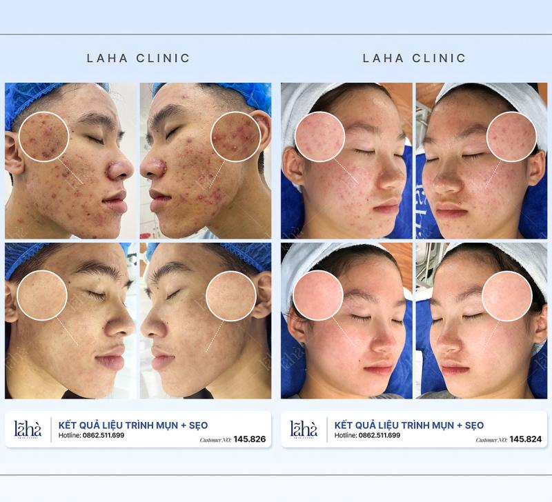 Kết quả điều trị mụn tại Lã Hà Clinic