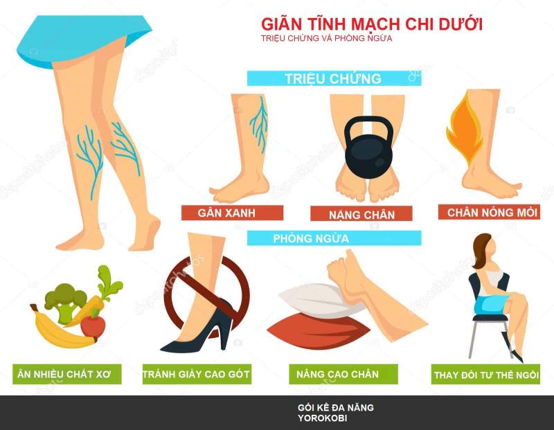 Phòng ngừa suy giãn tĩnh mạch