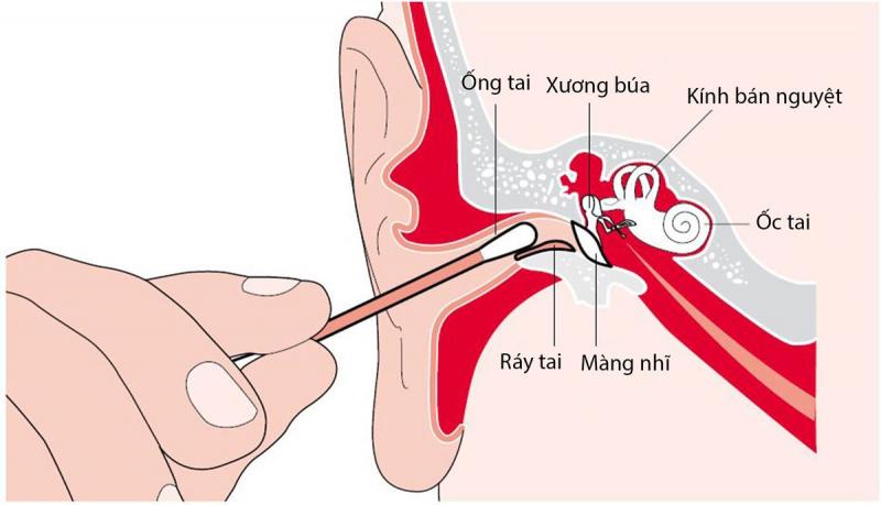 Ráy tai thực chất là một loại mồ hôi