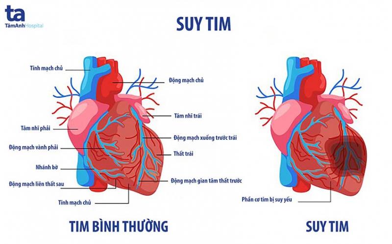 Suy tim - một trong những biến chứng của rối loạn nhịp tim