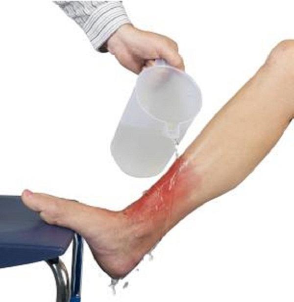Nên sơ cứu vết bỏng ngay lập tức