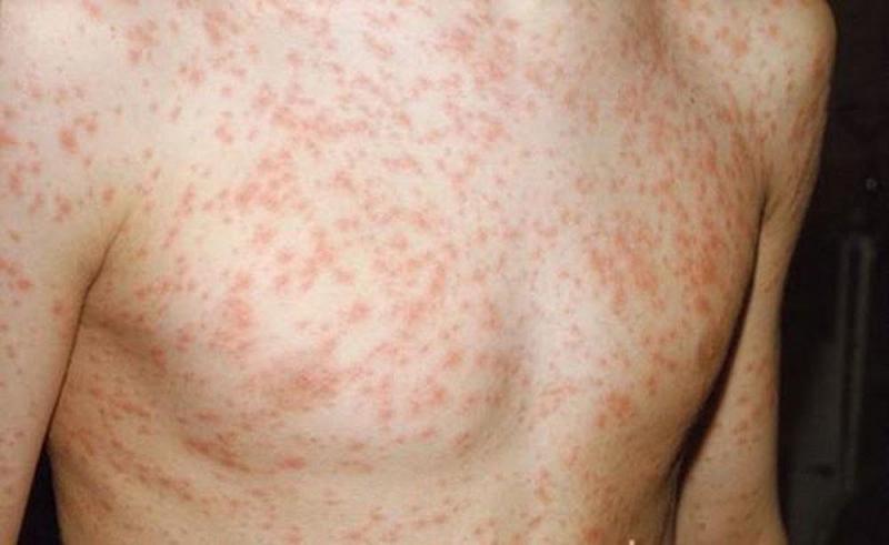 Sốt kèm theo nốt mẩn đỏ, đau cổ và nhức đầu