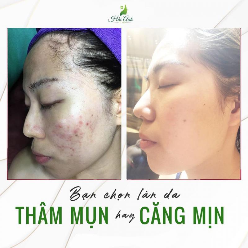 Spa Hải Anh sẽ giúp bạn có gương mặt sạch mụn.