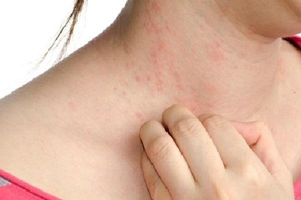 Sử dụng các loại phụ kiện bằng kim loại kém chất lượng gây tổn hại cho da