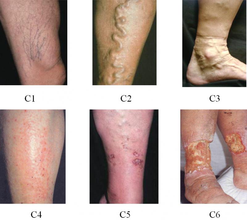 Suy giãn tĩnh mạch có nguy hiểm không?