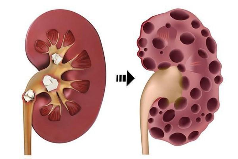 Suy thận là tình trạng suy giảm các chức năng của thận