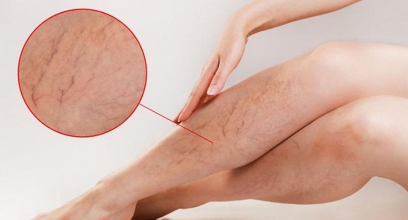 Một số tác dụng không mong muốn khi dùng sản phẩm trong thời gian dài như gây giãn mạch hoặc sung huyết trở lại