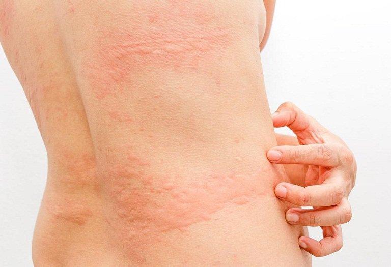Hình ảnh triệu chứng do tác dụng phụ gây nên